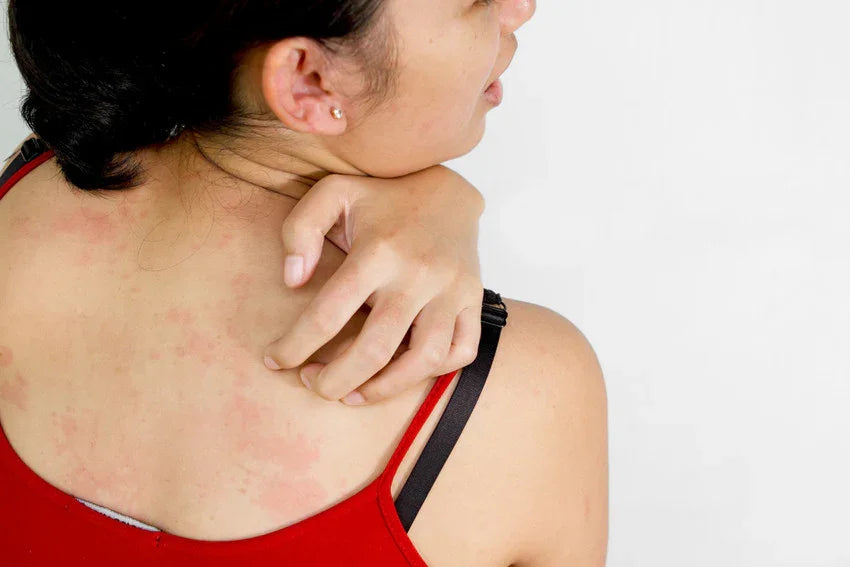 Clothing Allergy: 5 Reasons, 7 Symptoms, and 6 Ways to Control